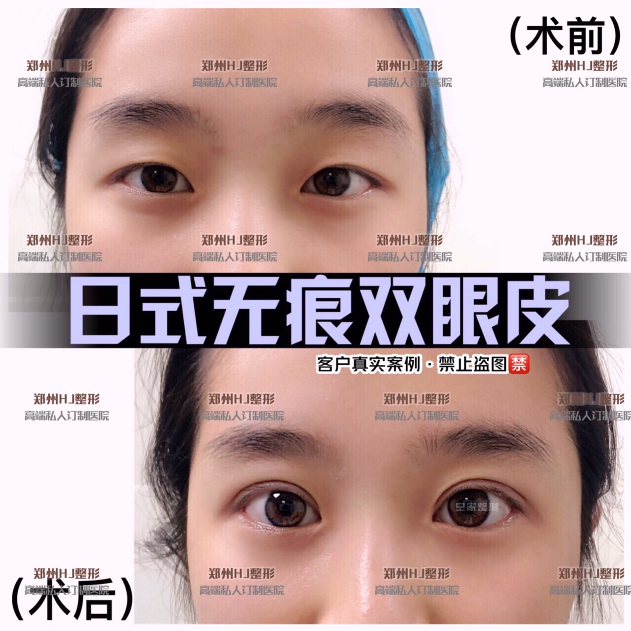 郑州双眼皮手术哪家好 日式无痕双眼皮的原理是什么 日式无痕双眼皮永久吗 龙潭资讯网